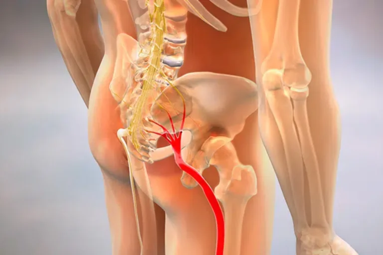 Persona con gesto de dolor tocando la espalda baja y la pierna debido a dolor de ciática causado por irritación del nervio ciático.