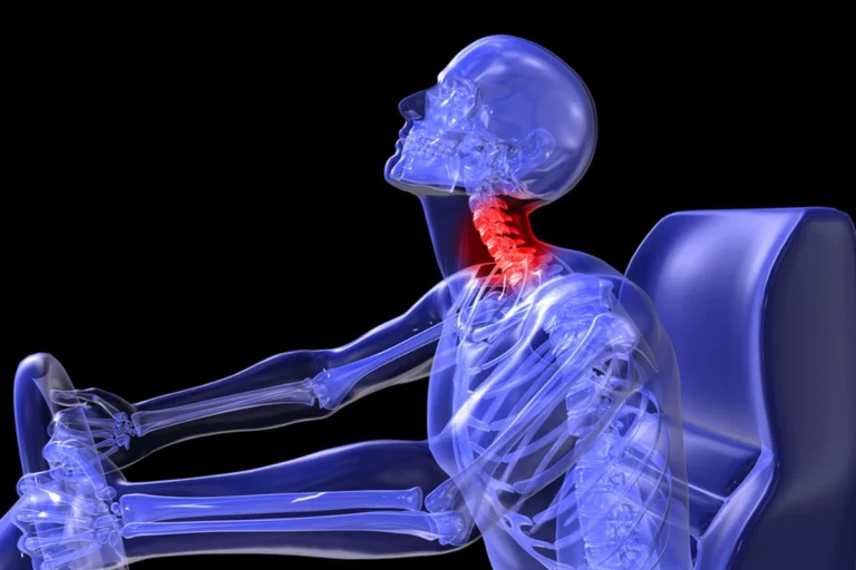 Persona con dolor y rigidez en el cuello después de un accidente de tránsito, síntomas comunes del latigazo cervical.